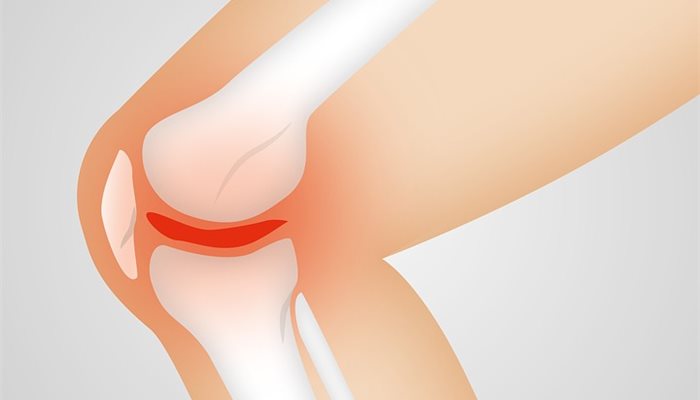 Osteoartritída